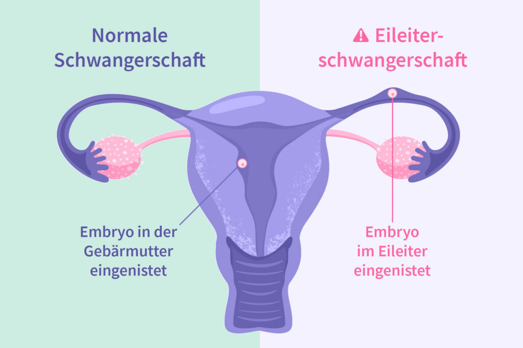 Eileiterschwangerschaft im Unterscheid zur normalen Schwangerschaft - Darstellung Uterus mit Einnistungen - OvulaRing