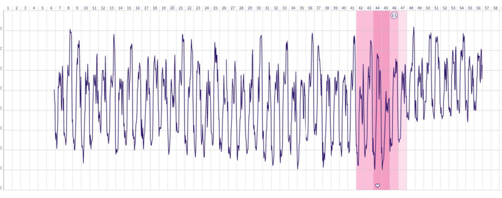 Precise and simple cycle diagnostics with OvulaRing – also possible with PCOS