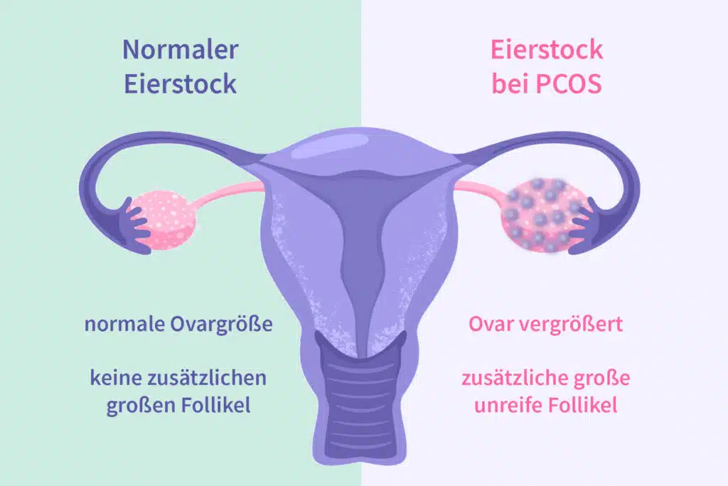 polyzystisches Ovarialsyndrom - Unterschied normales Ovar vs. PCOS - OvulaRing